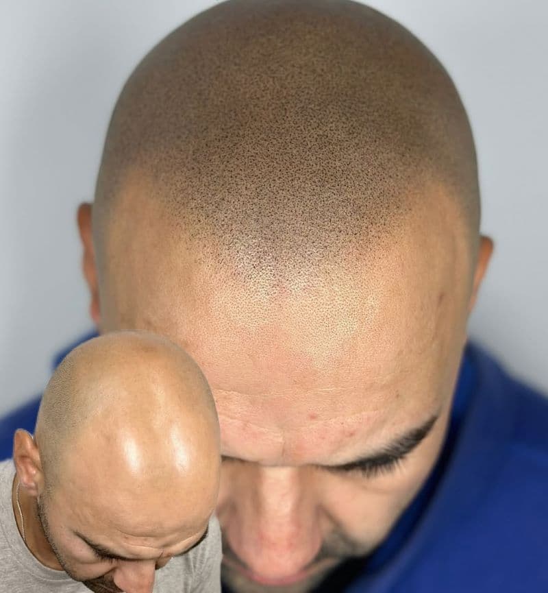 Micropigmentation of the hair 1